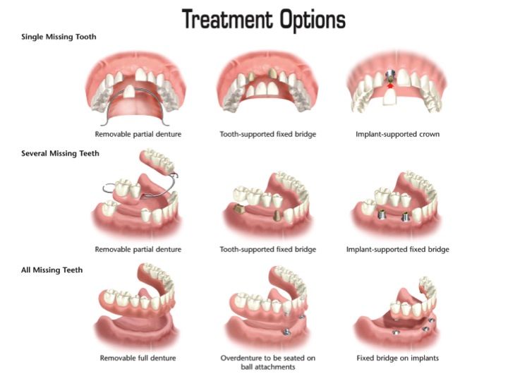Replace Missing Teeth Naperville Il Dental Implants